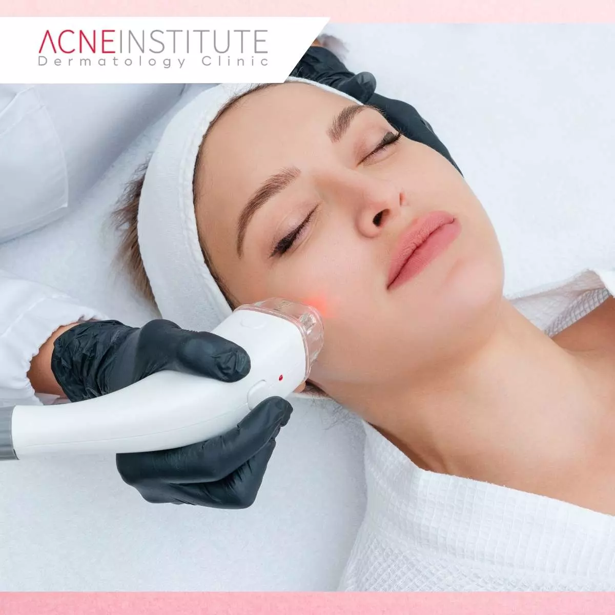 Seberapa Efektif Laser Treatment dalam Mengatasi Dark Spot?