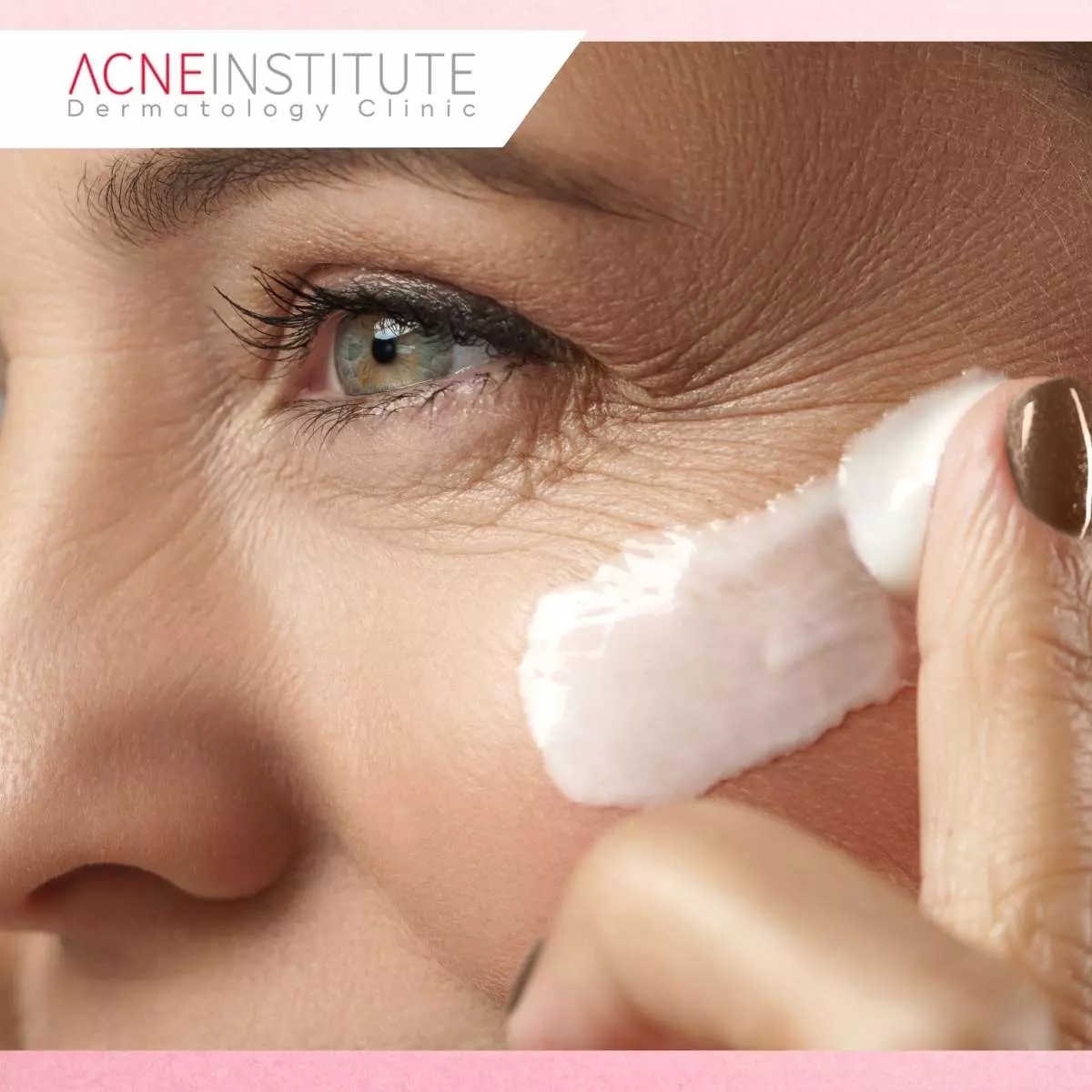 Manfaat Treatment Peel di Acne Institute Surabaya