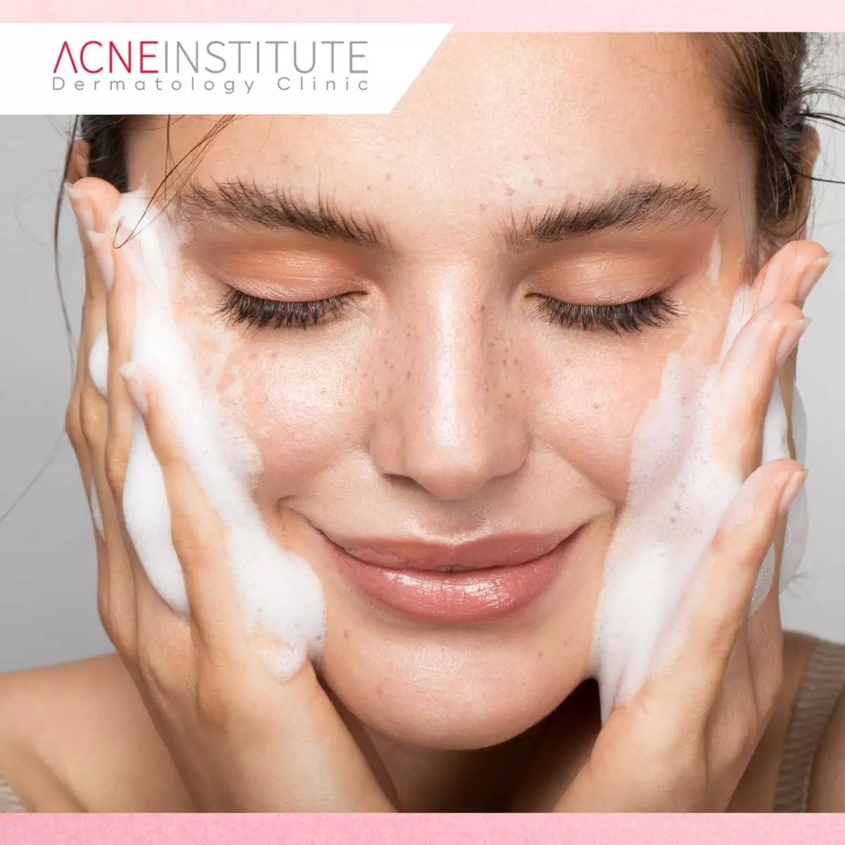 Tips Aman Sebelum Memilih Treatment Jerawat