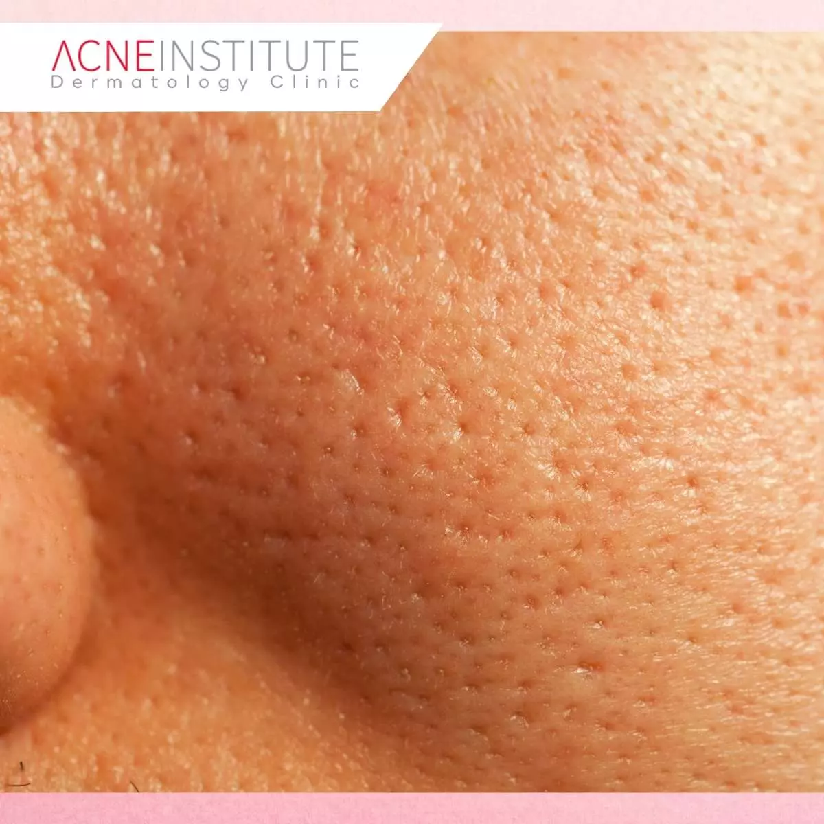 Produk Skincare Acne Institute yang Efektif untuk Perlindungan Anti-Polusi