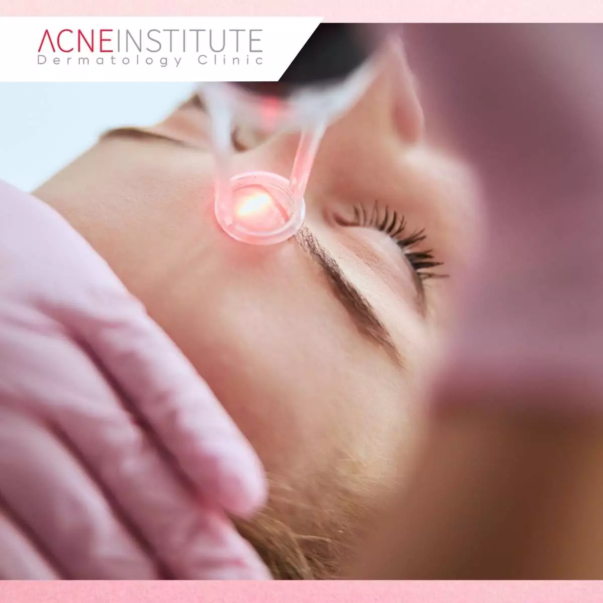 Tips Optimal Kombinasi Perawatan dan Skincare untuk Jerawat