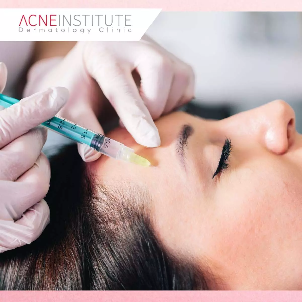 Apa Itu Collagen Stimulator & Cara Kerjanya