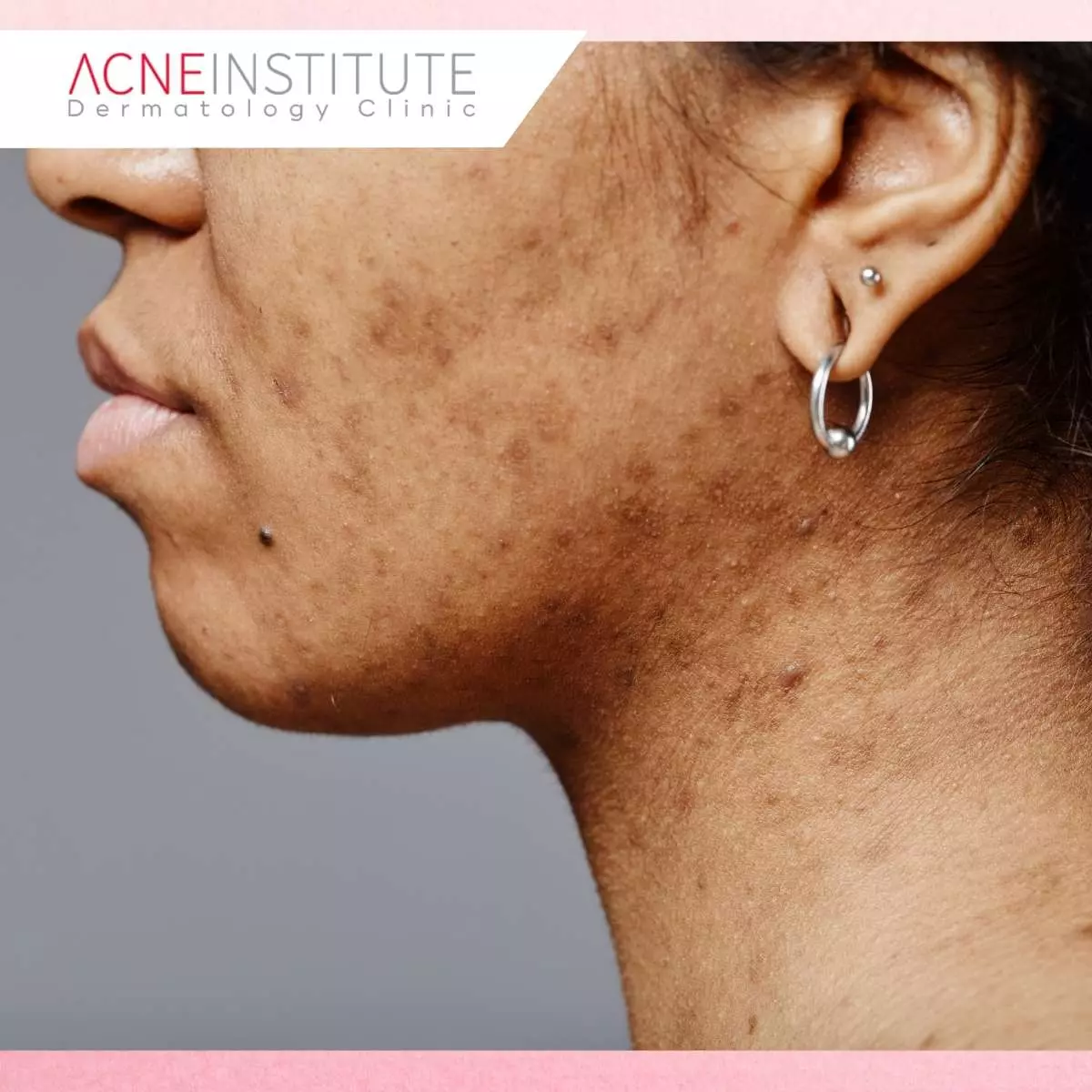 Fungal Acne Bukan Jerawat Biasa