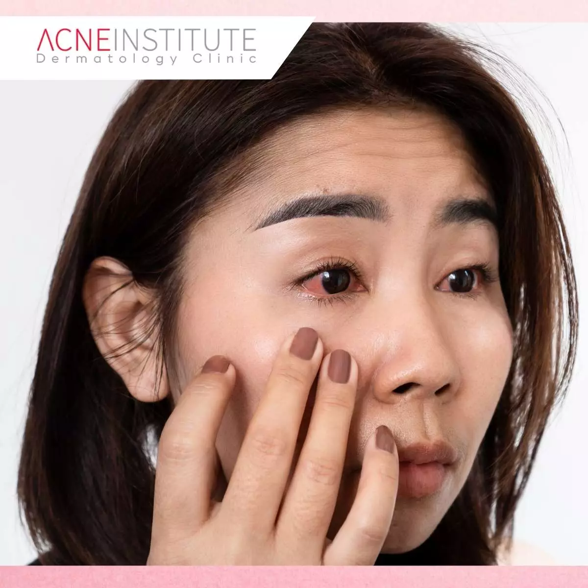 Perbedaan Jerawat Biasa dengan Fungal Acne