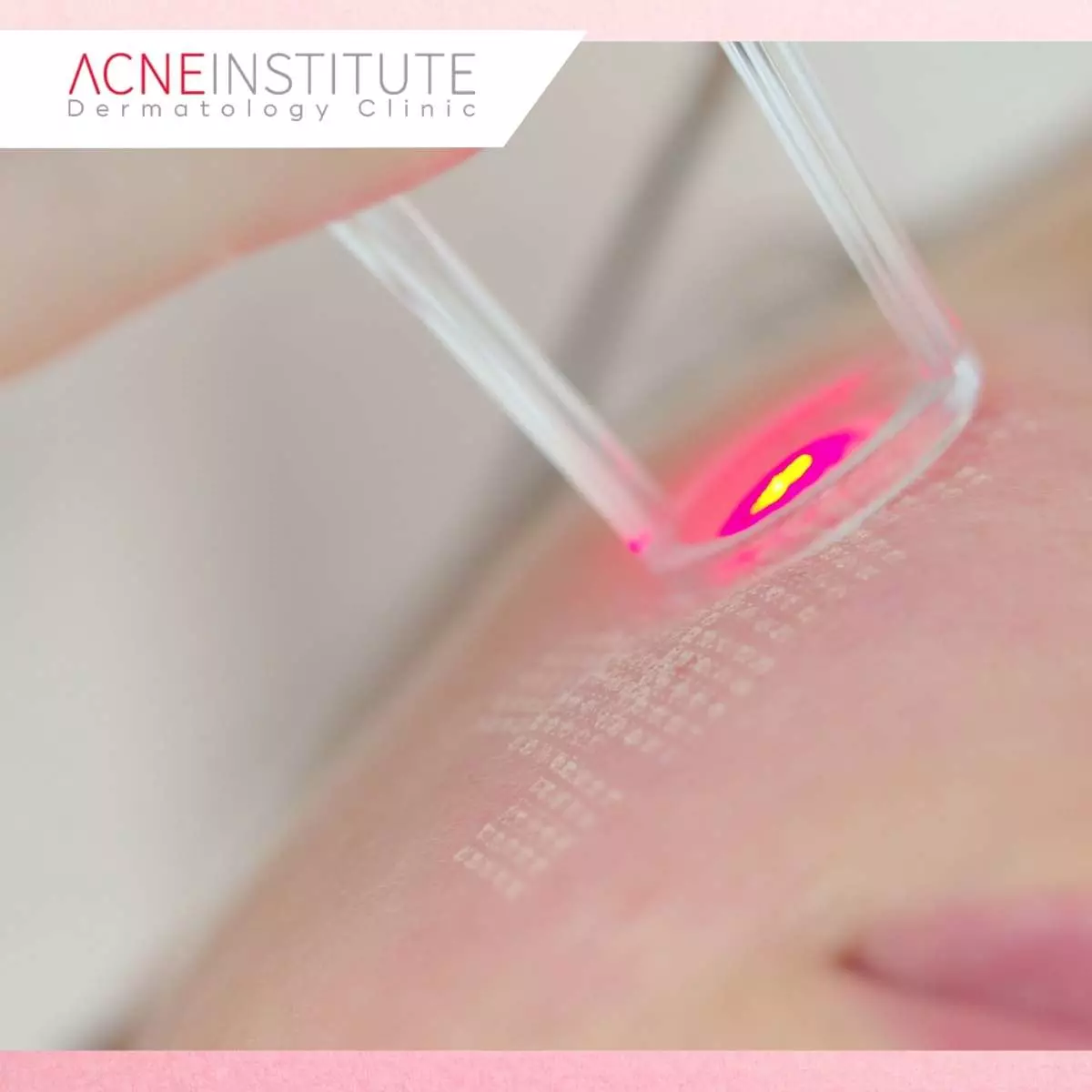 Kenapa Harus di Acne Institute Surabaya?