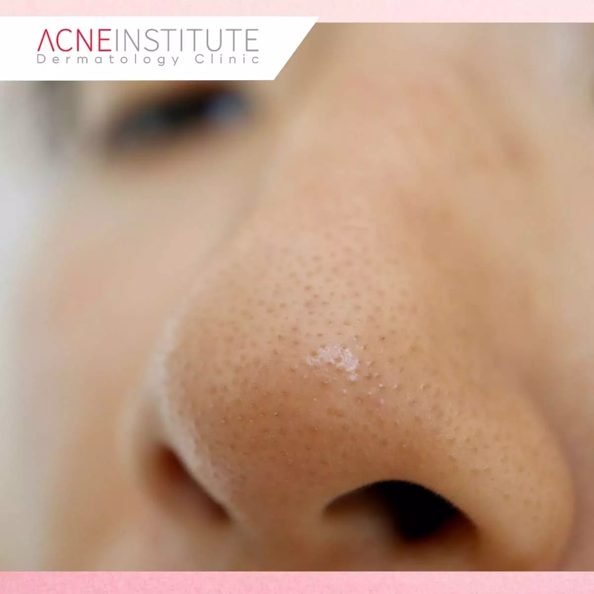 Manfaat Magic Pore Treatment