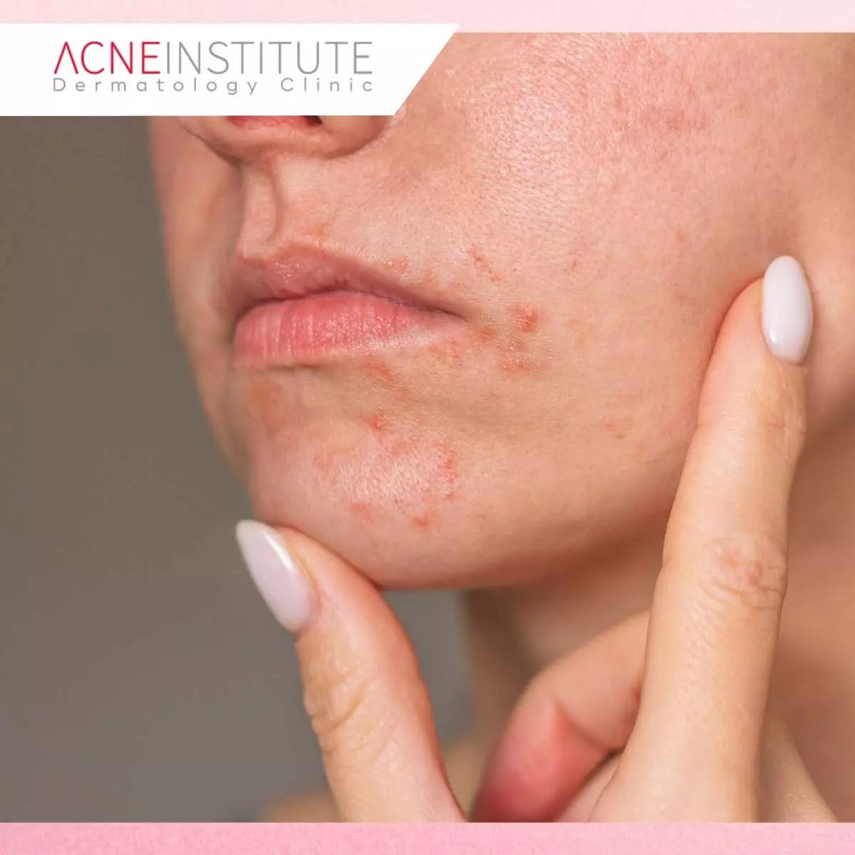 Apa Itu Bruntusan Sekitar Mulut dan Dermatitis Perioral?
