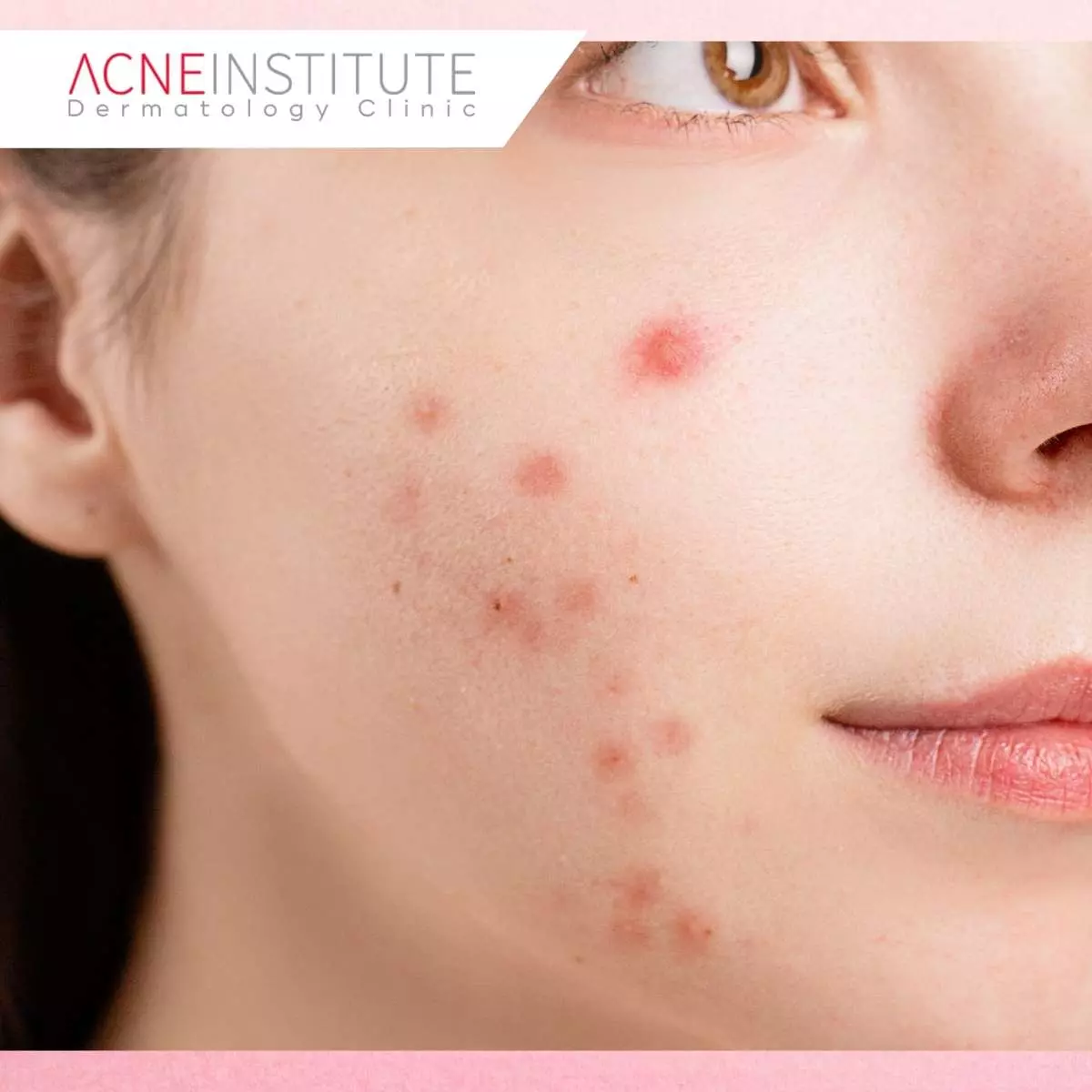 Apakah Acne Patch dan Obat Totol Bisa Digunakan Bersamaan?
