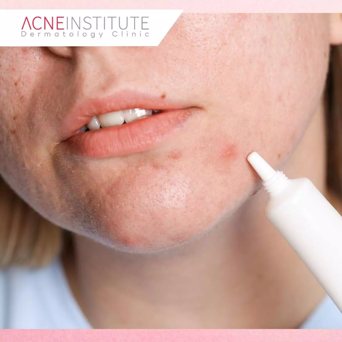 Tips Memaksimalkan Hasil Acne Patch vs Obat Totol