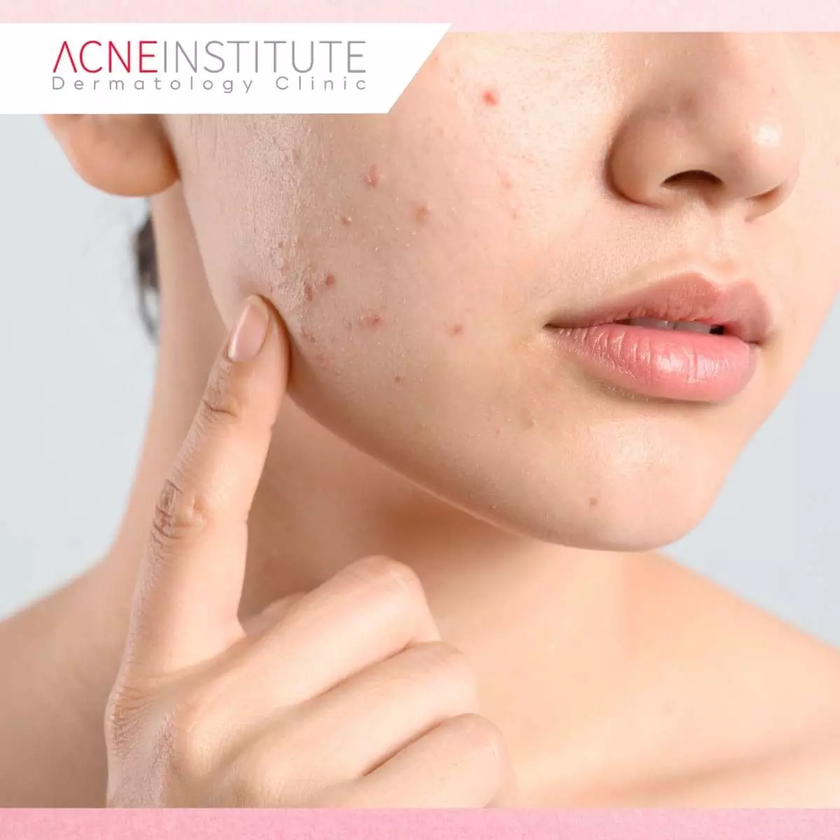 Manfaat Treatment NBeam untuk Bekas Jerawat dan Flek Hitam