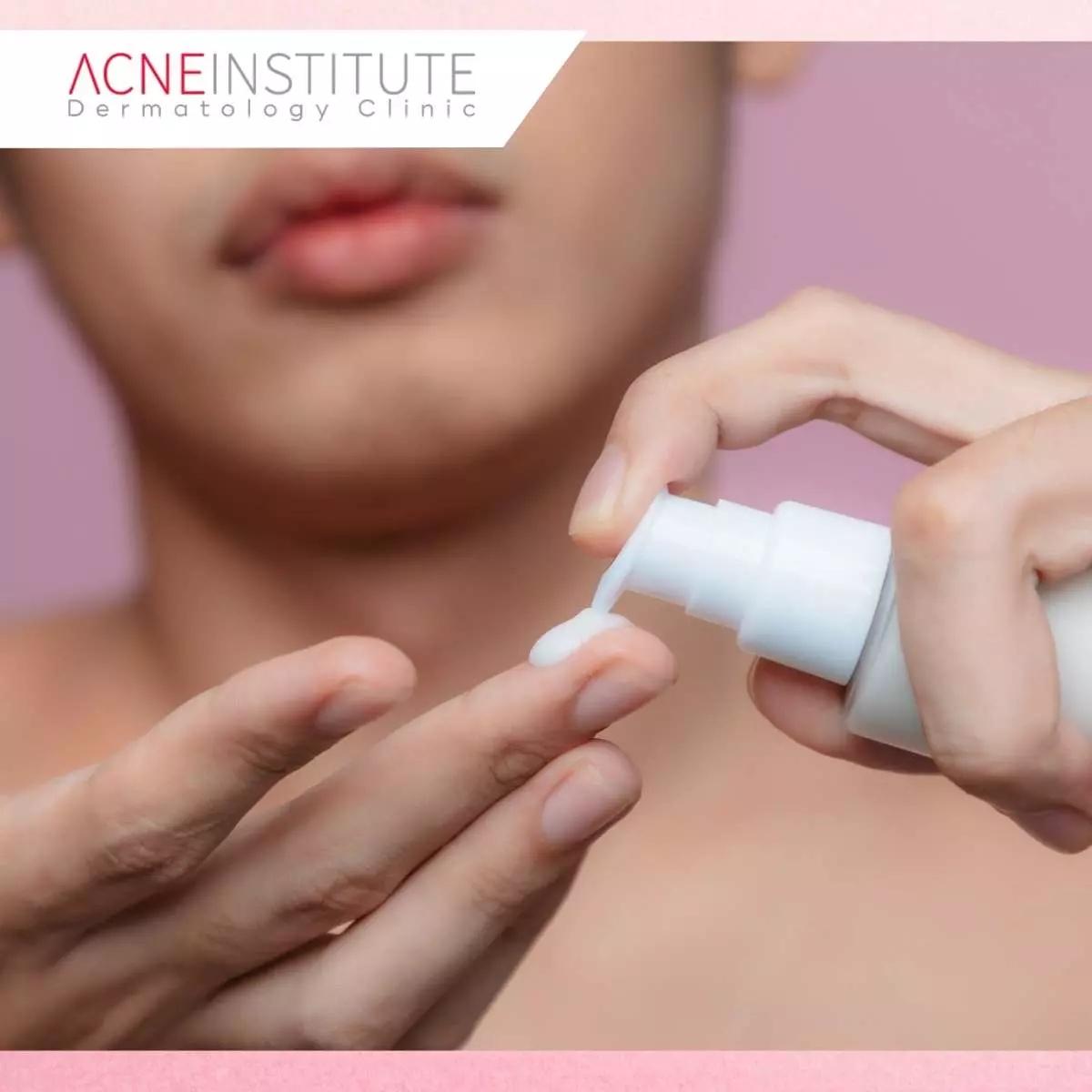 Skincare yang Tepat untuk Bekas Jerawat PIE