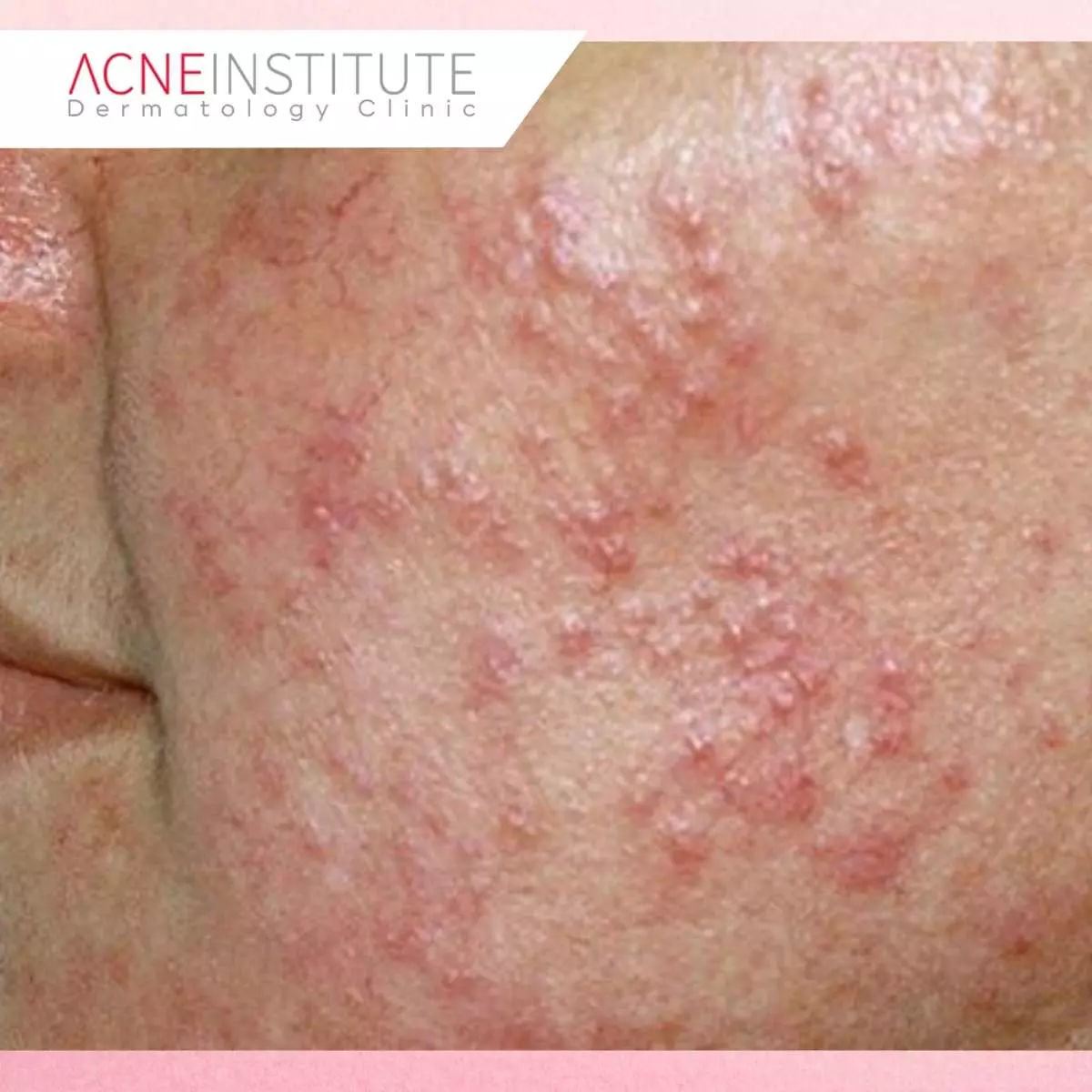 Prosedur Treatment Laser Vbeam dari Awal Hingga Setelah Perawatan