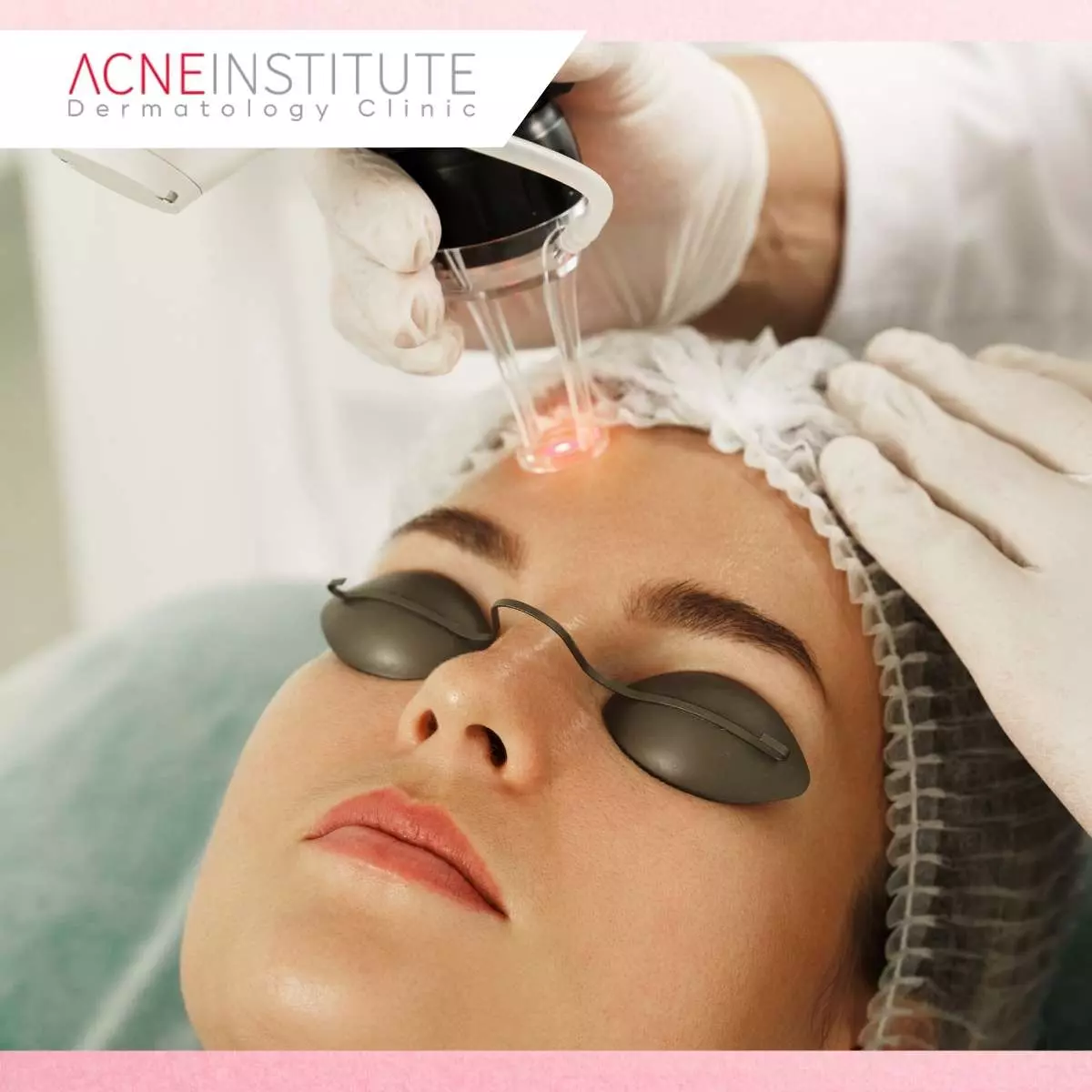 Berapa Kali Treatment Laser Vbeam Dibutuhkan untuk Hasil Optimal?