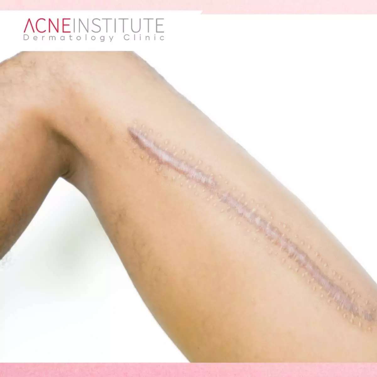 Berapa Kali Injeksi Keloid Dibutuhkan untuk Hasil Optimal?