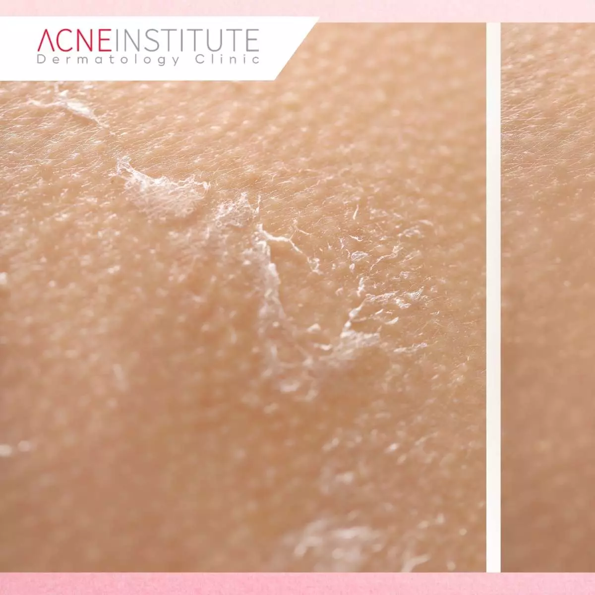 Perawatan Setelah Treatment Agar Hasil Maksimal