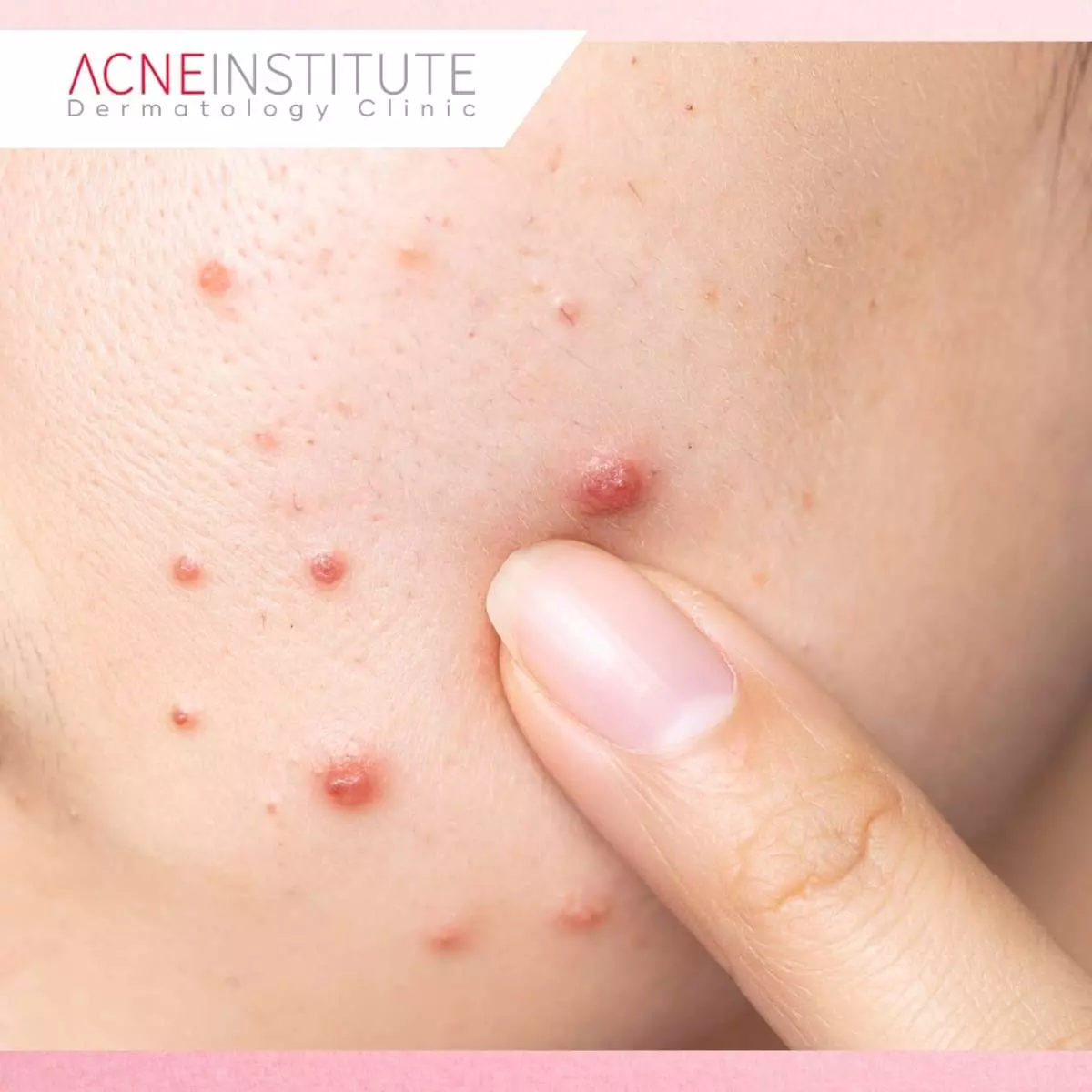 Kriteria Memilih Treatment Wajah Agar Glowing Saat Lebaran