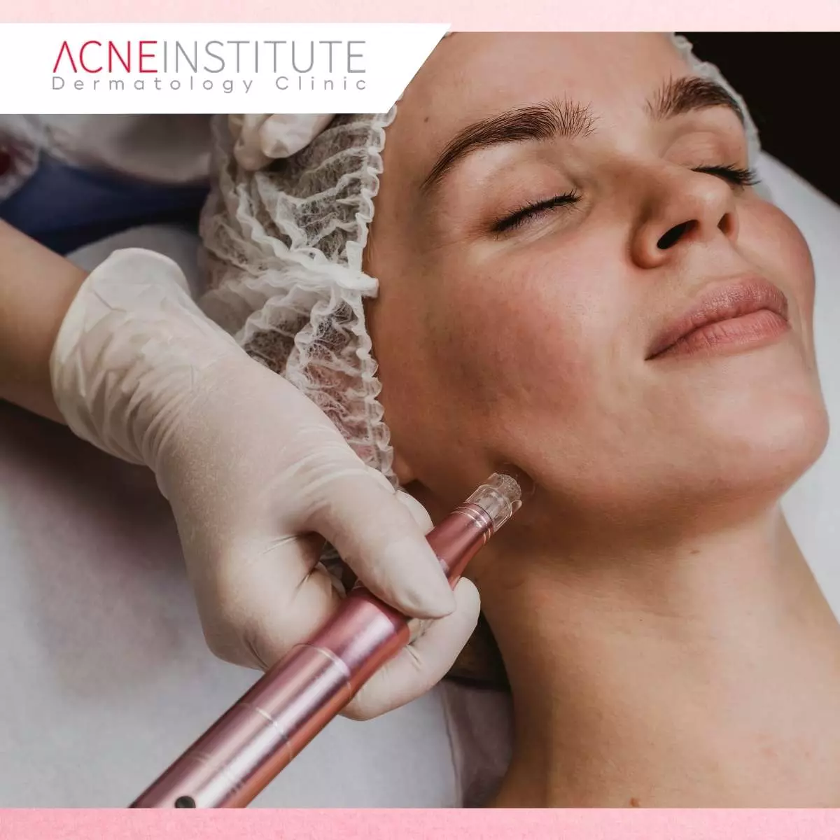Cara Memilih Treatment Pori Pori Wajah yang Tepat