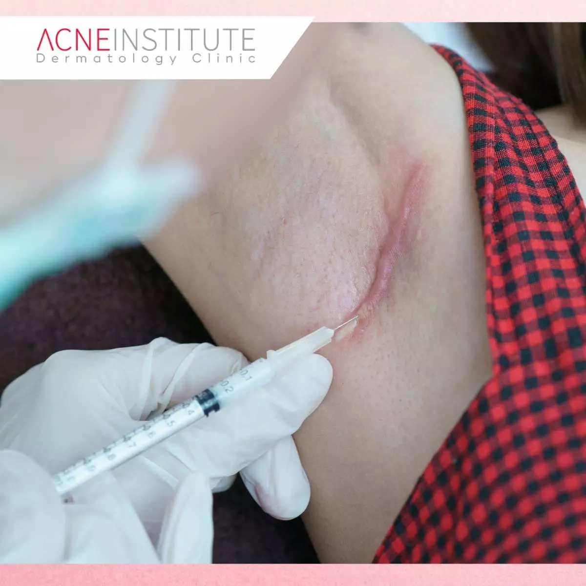 Kenapa Harus Treatment Keloid di Acne Institute