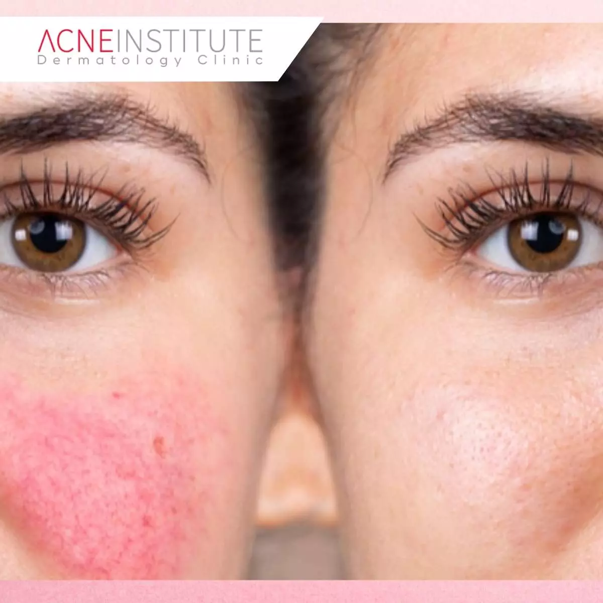 Tips Memaksimalkan Hasil Laser Vbeam untuk Keloid