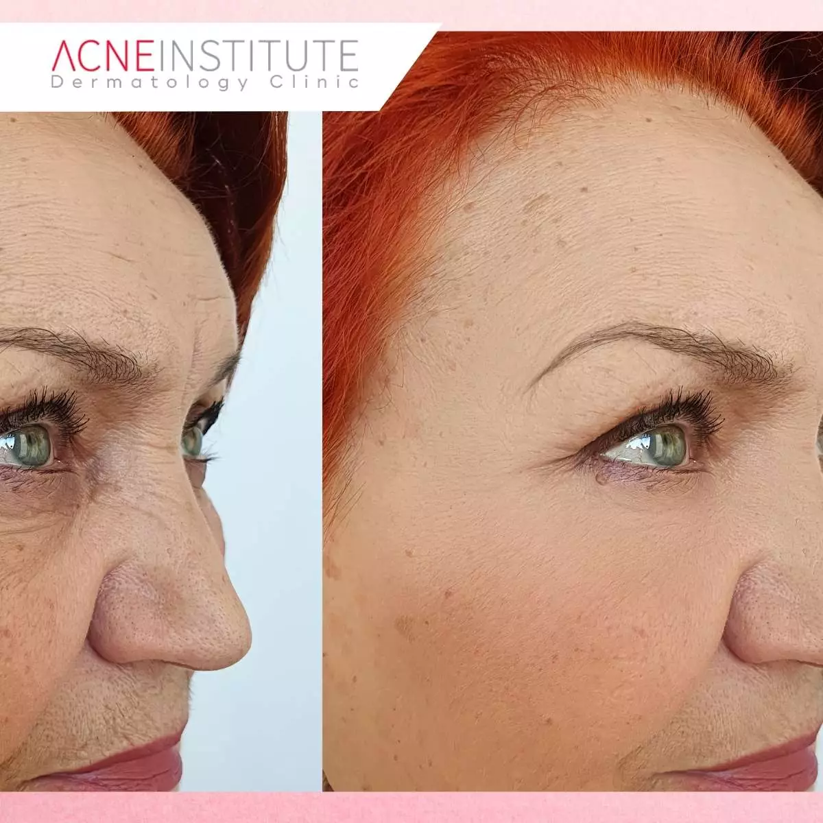 Hasil Botox Sebelum dan Sesudah Treatment