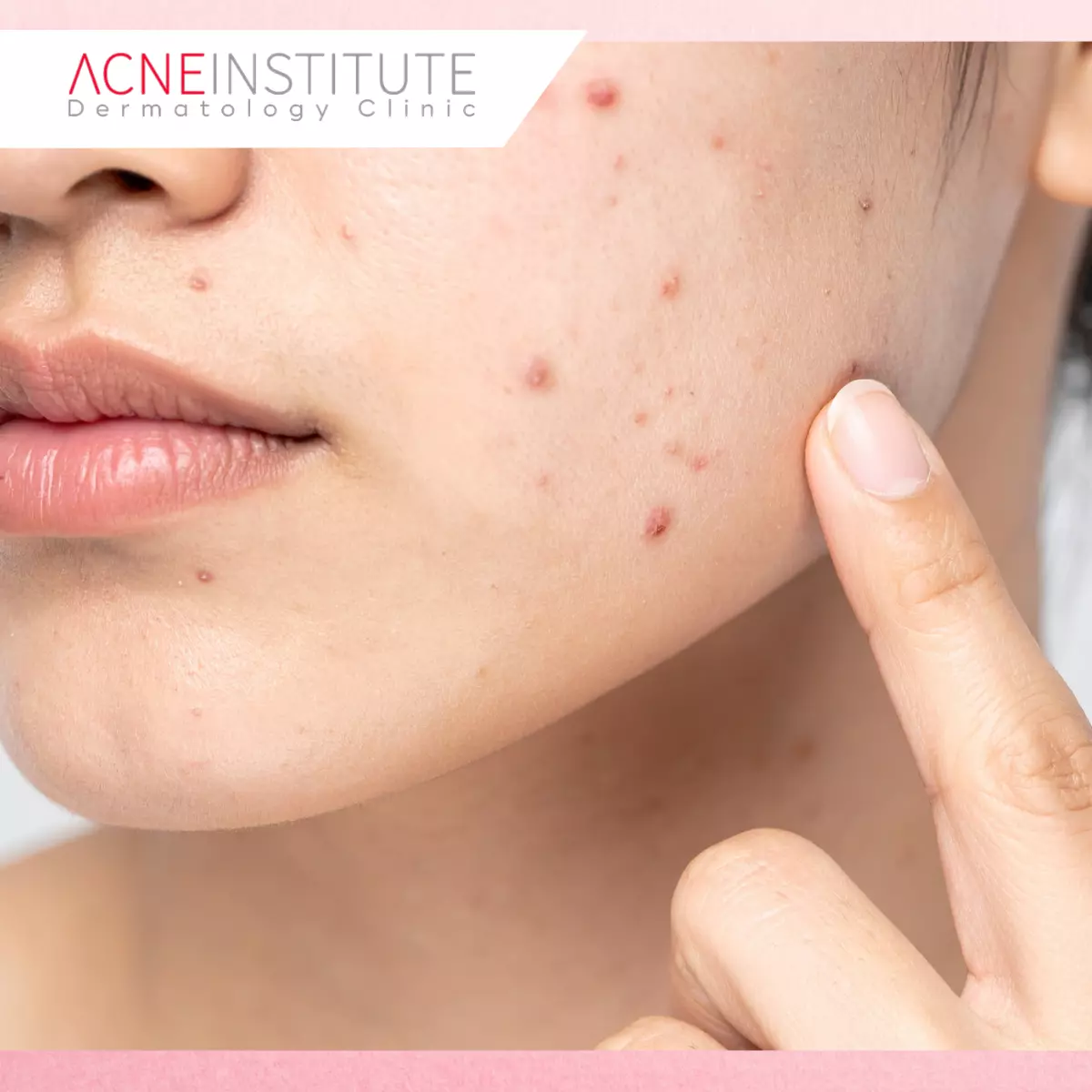 Tantangan Kulit Sensitif dan Acne Prone dalam Perawatan Pori