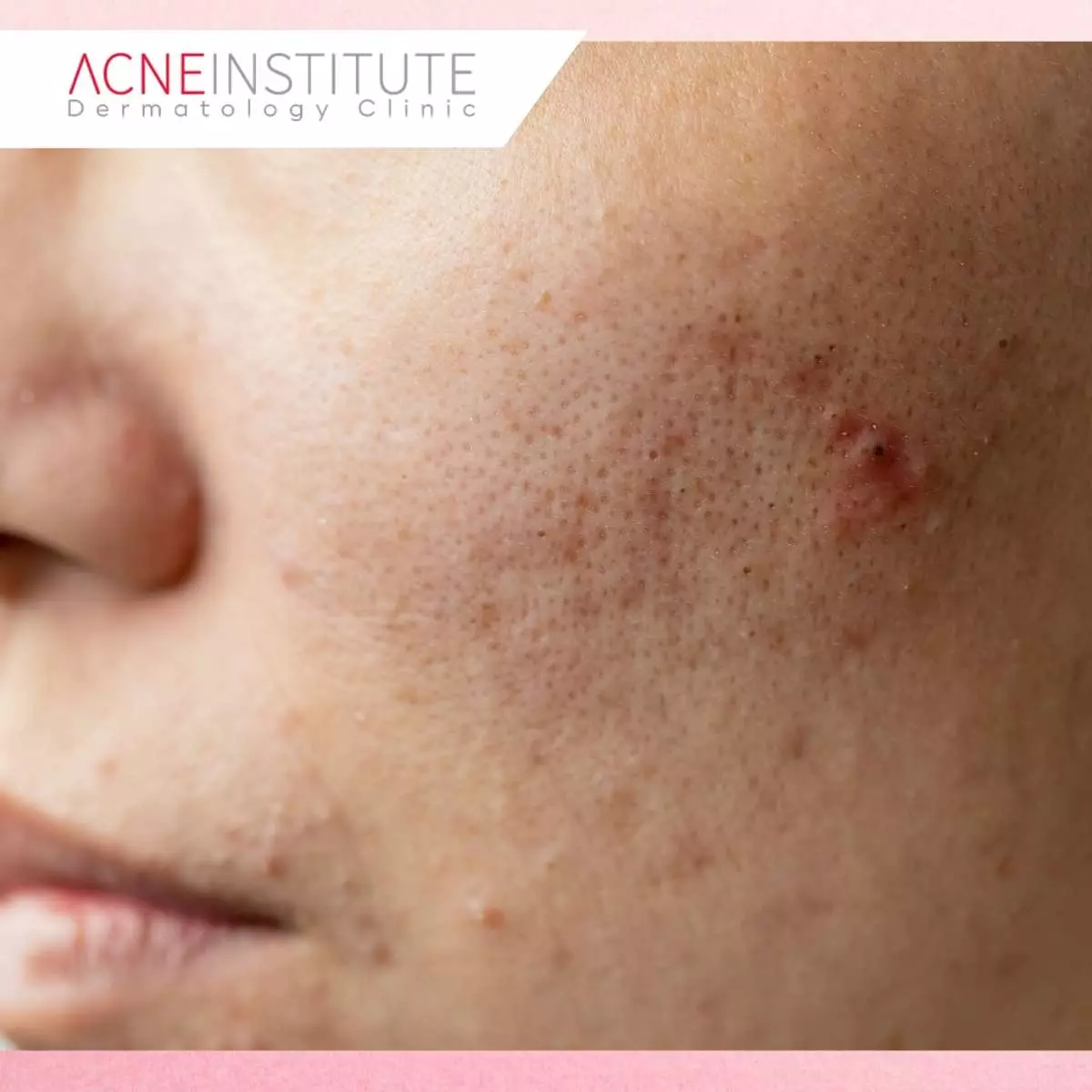 Tanda-Tanda Receptor Fatigue Skincare