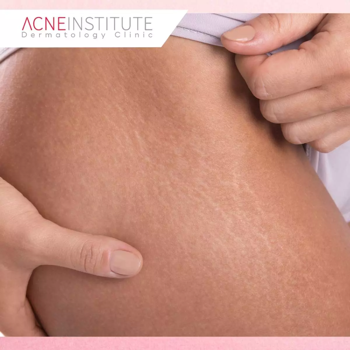 Penyebab Stretch Mark Membandel