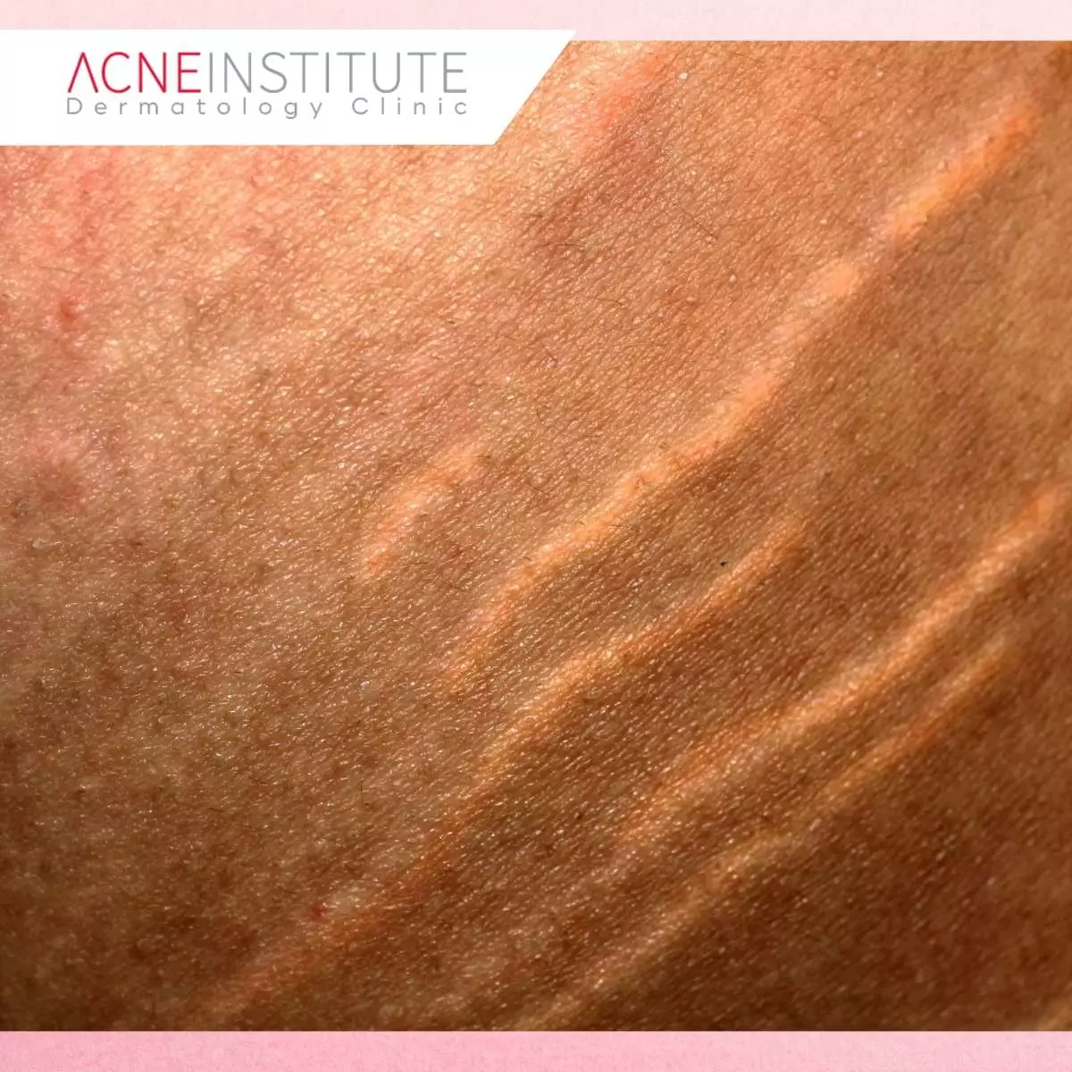 Tips Maksimalkan Hasil Treatment Stretch Mark