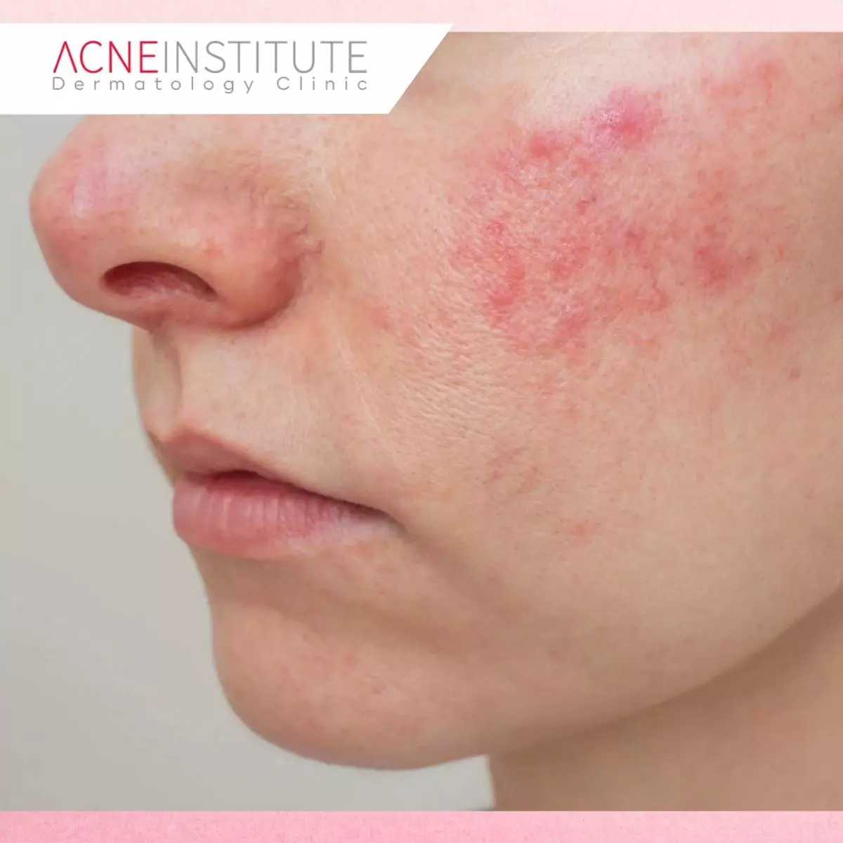 Faktor di Iklim Tropis yang Memicu Flare-Up Rosacea