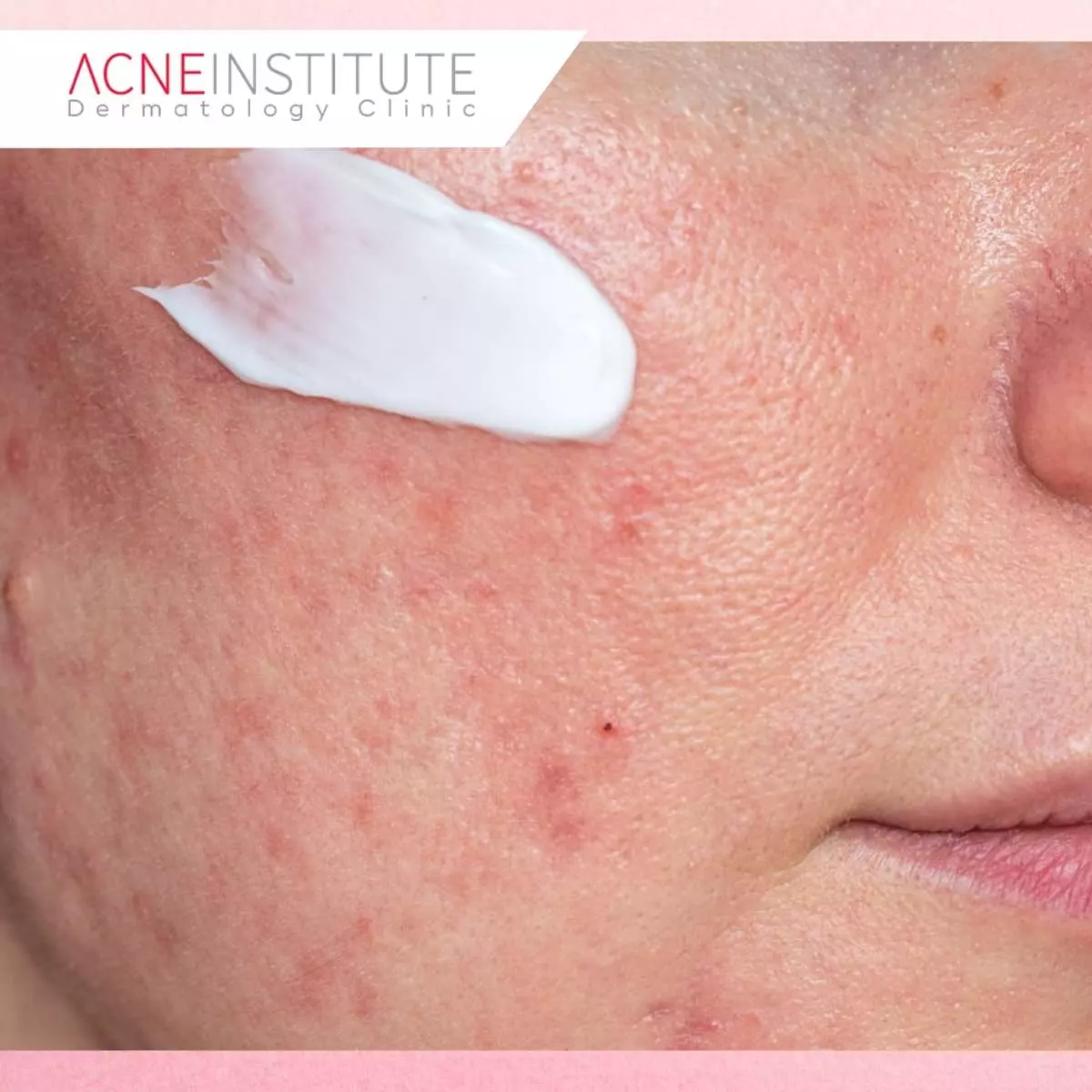 Tips Perawatan Harian agar Rosacea Tidak Kambuh
