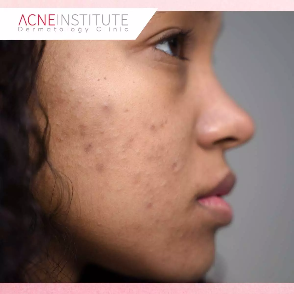 Bekas Jerawat dan Keloid, Mengapa Sulit Hilang dengan Perawatan Biasa?