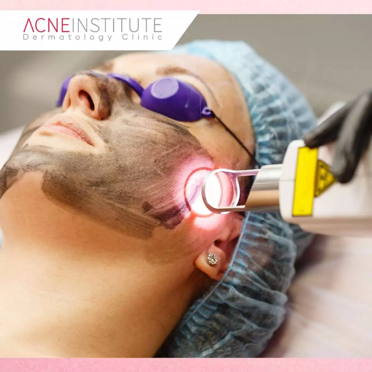 Apa itu Treatment Laser Frax?