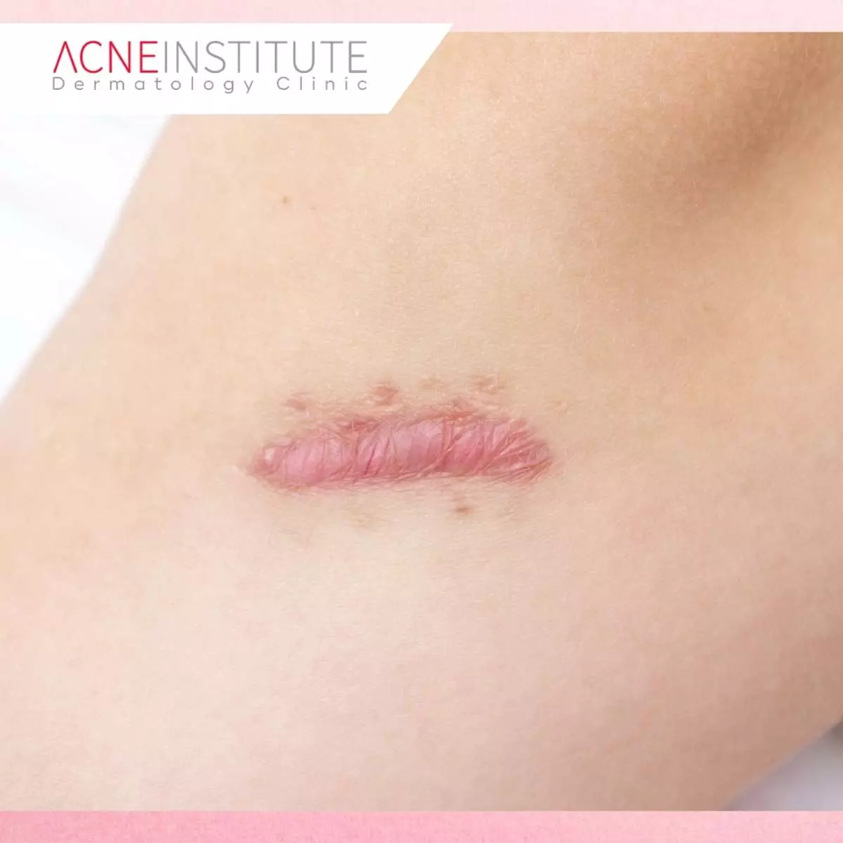 Apakah Laser Frax Efektif untuk Keloid?