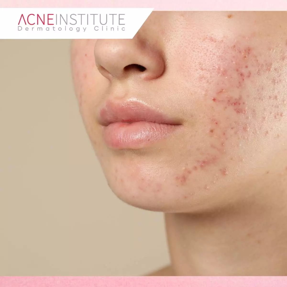 Mengapa Satu Treatment Tidak Bisa Mengatasi Semua Jenis Bekas Jerawat?