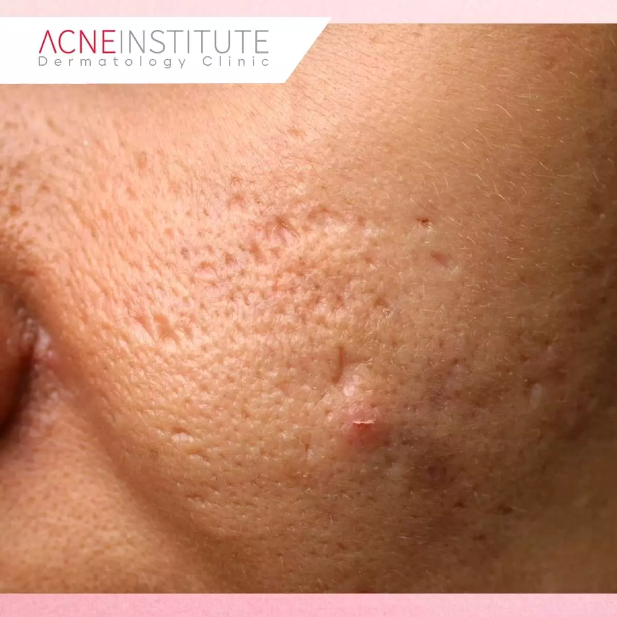 Pilihan Treatment Berdasarkan Jenis Bekas Jerawat