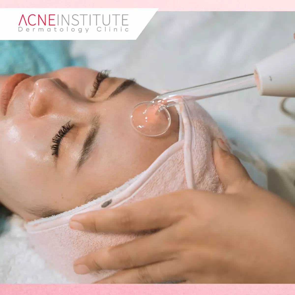 Treatment Bopeng Jerawat Modern Berbeda dari Metode Lama