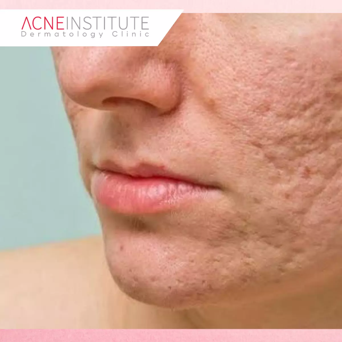 Keunggulan Modern Acne Scar Treatment