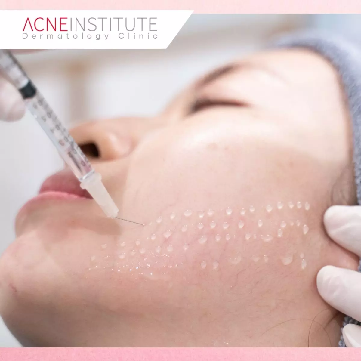 Mengenal Acne Institute sebagai Klinik Khusus Jerawat Jakarta