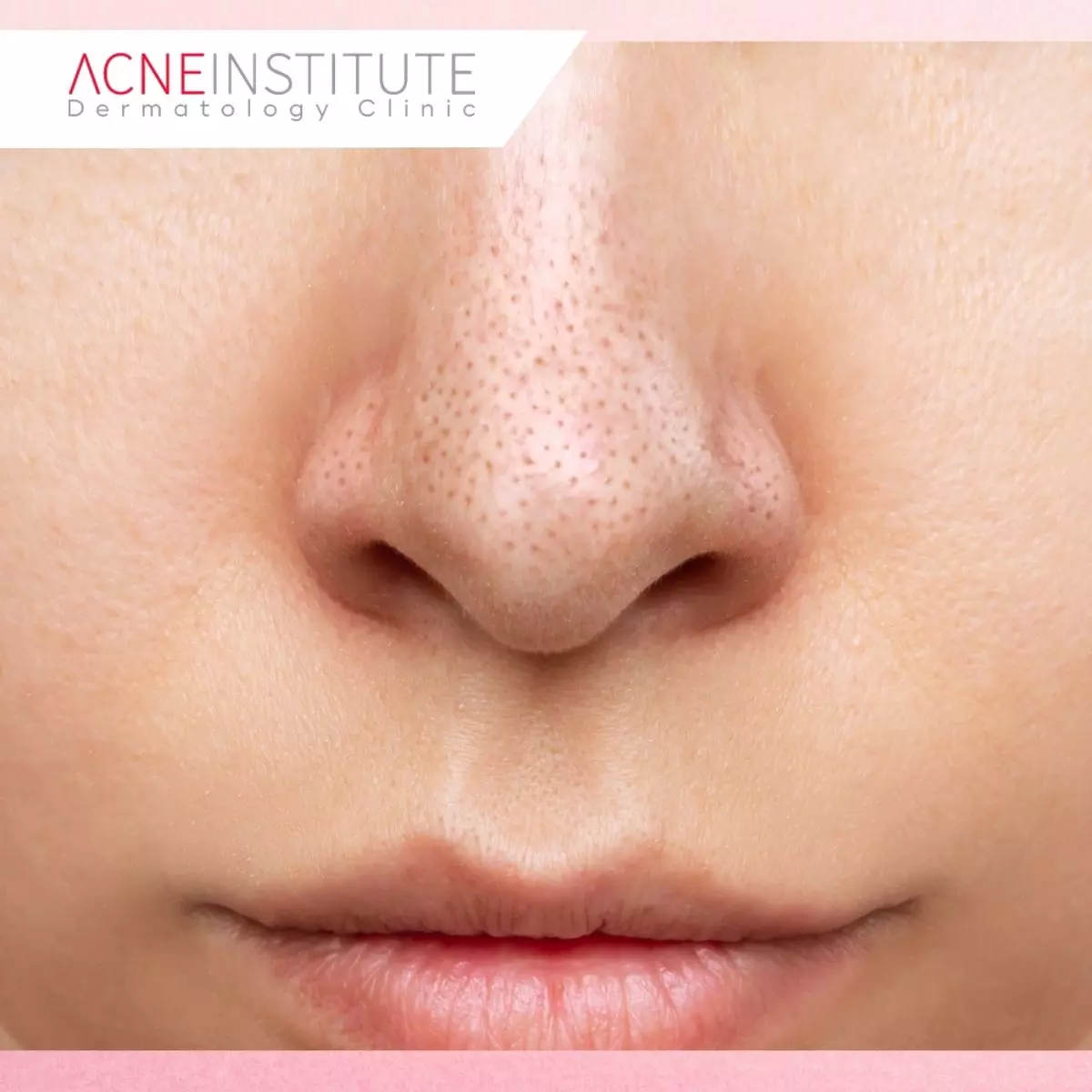 Tips Mencegah Jerawat di Hidung Muncul Kembali