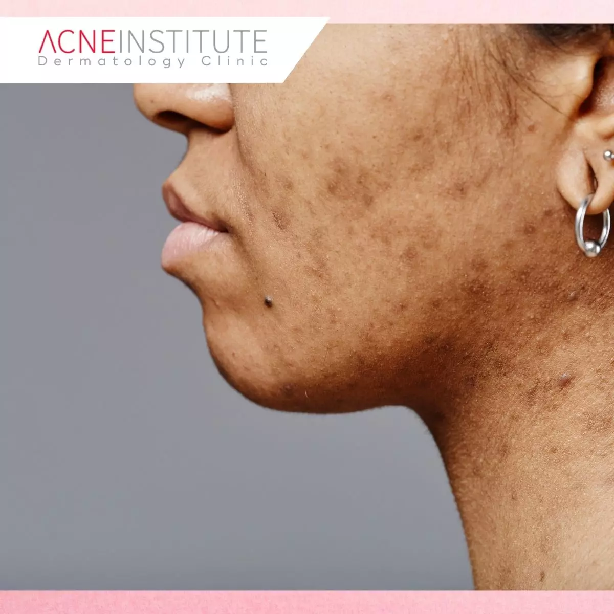 Kenali Jenis Bekas Jerawat Sebelum Memilih Treatment
