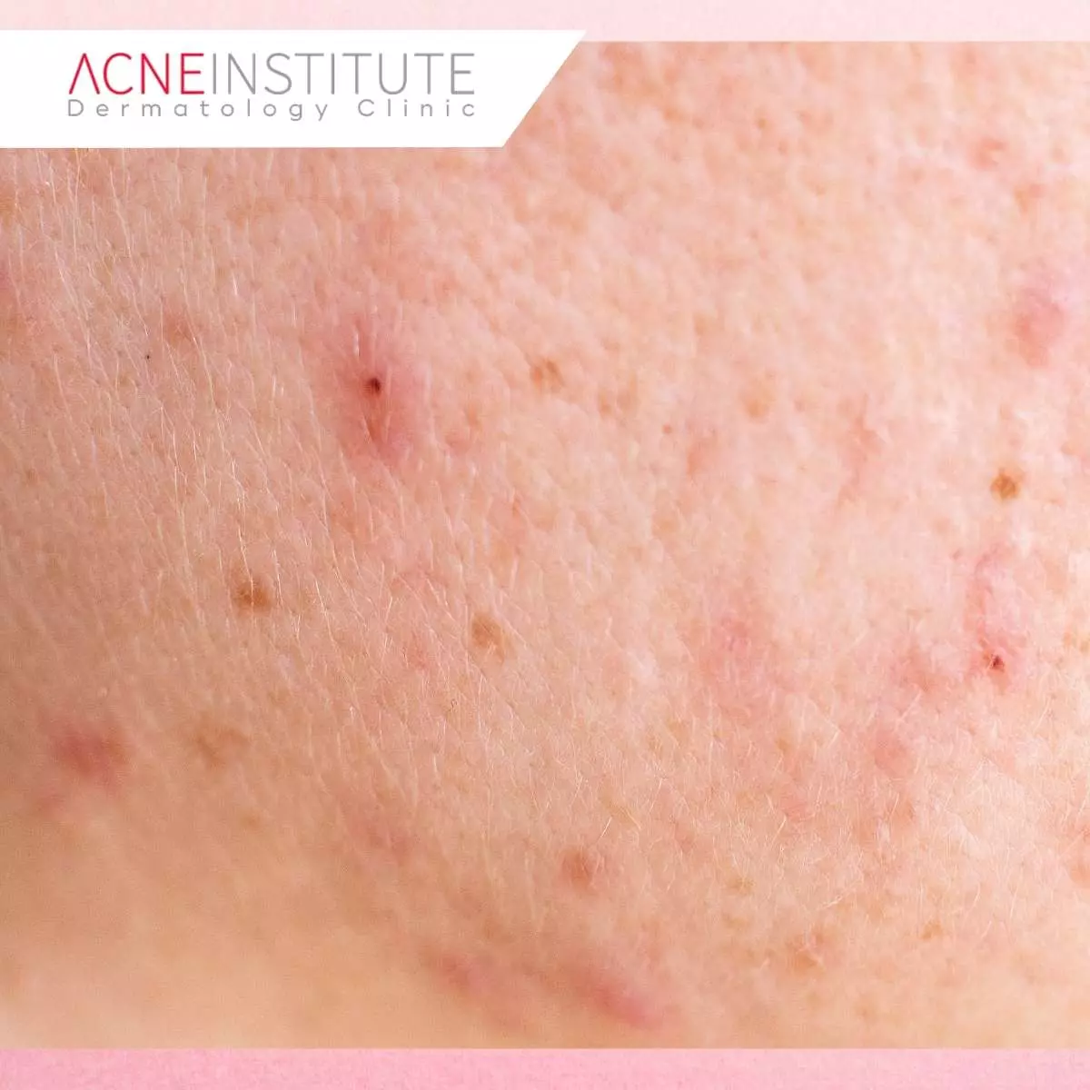 Mengapa Bekas Jerawat Merah Tidak Selalu Hilang dengan Skincare?