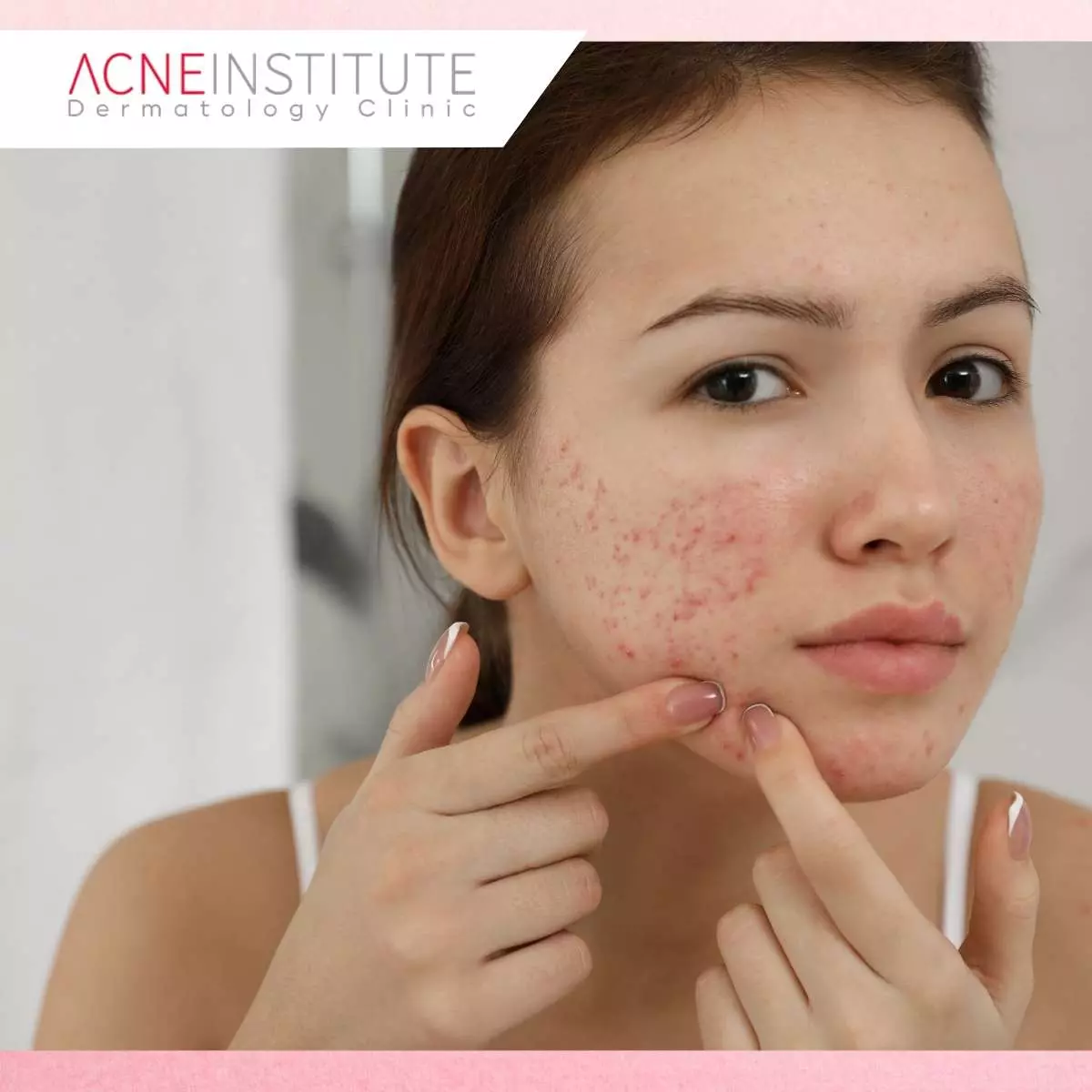 Berapa Lama Hasil Treatment Bekas Jerawat Terlihat?