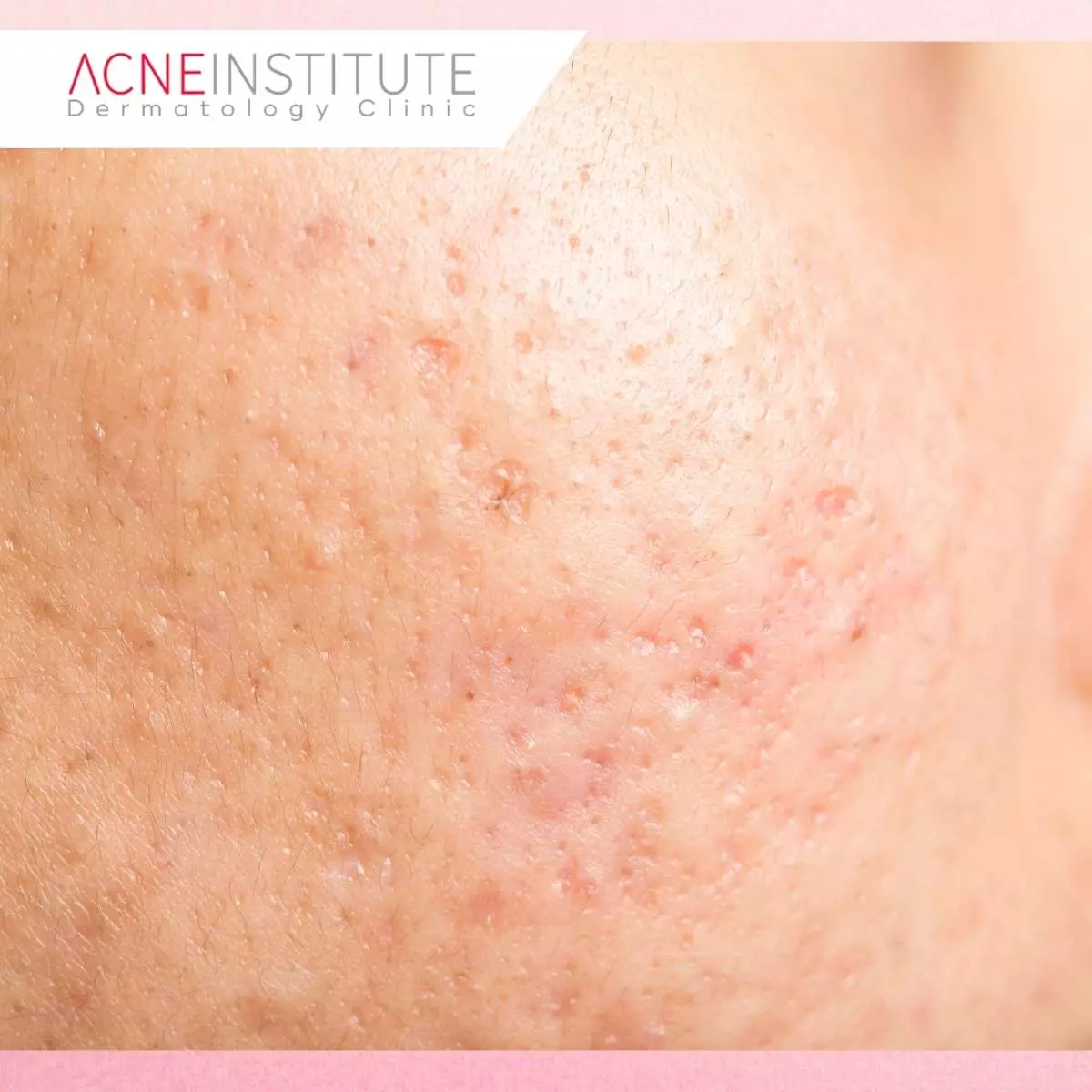 Apa Itu Ice Pick Scar?