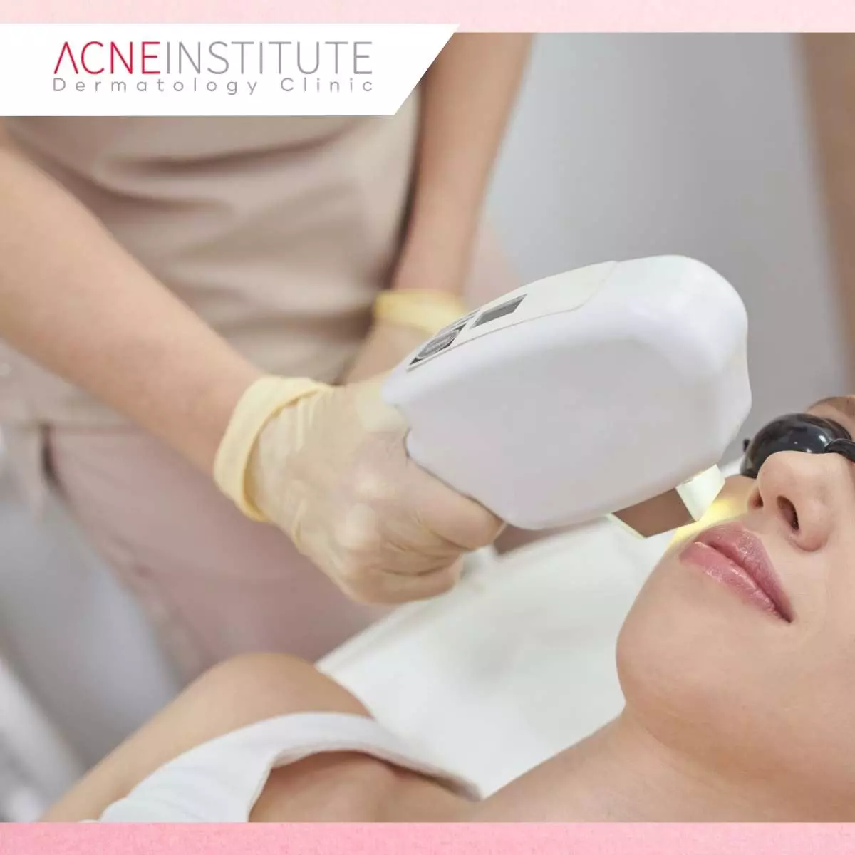 Mengenal Treatment V Beam dan LiTS VR untuk Bekas Jerawat Merah