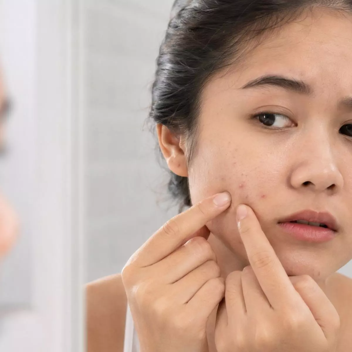 Apa Itu Bopeng dan Bedanya dengan Bekas Jerawat Biasa?