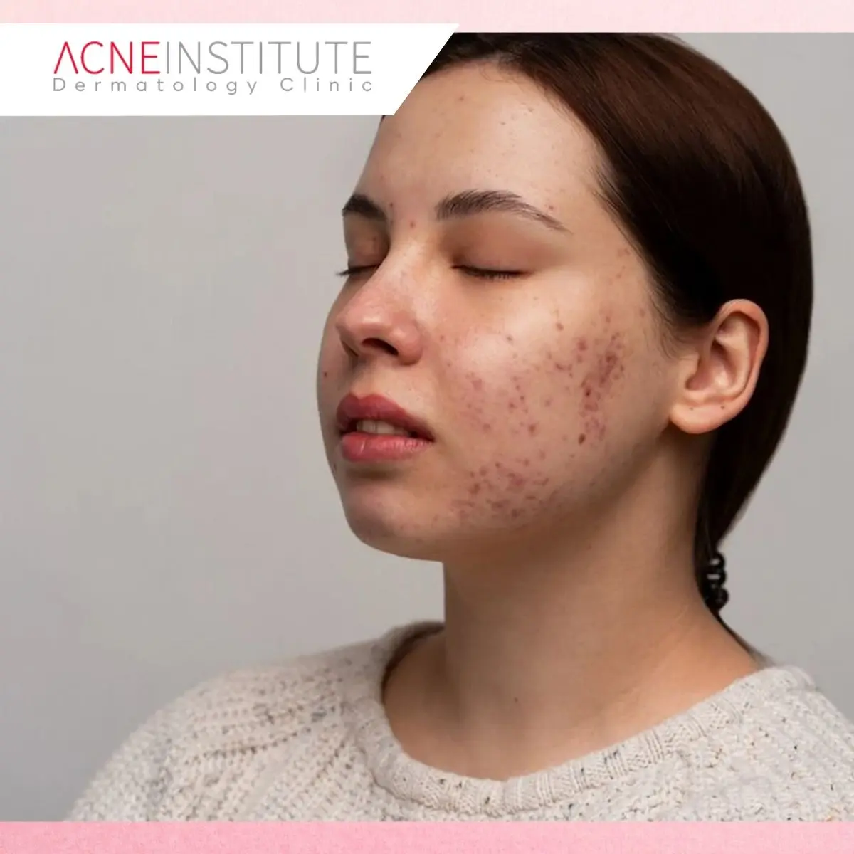 Berapa Kali Treatment Laser PIE dan PIH Dibutuhkan?
