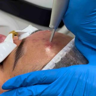 Laser Facial