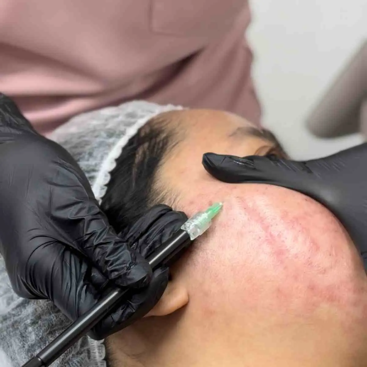 Acne Scar Surgery