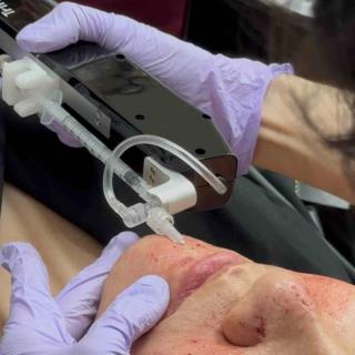 CO2 Subcision