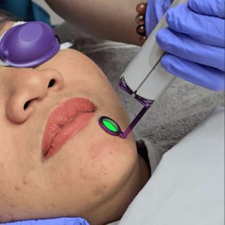 Laser Vbeam Perfecta